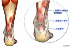 得了跟腱炎怎么办呢？多久可以好？ 跟腱周围炎